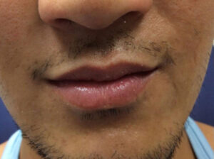 Lip Filler 1 After Image