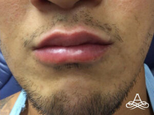 Lip Filler 1 Before Image