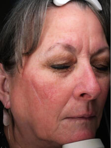 Facelift 17 After Image