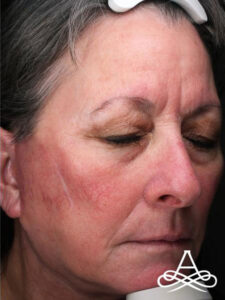 Facelift 17 Before Image