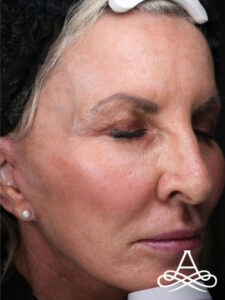 Facelift 19 Before Image