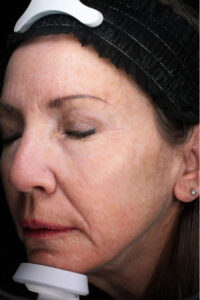 Co2 Laser Resurfacing 3 After Image