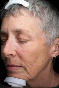 Co2 Laser Resurfacing 4 After Image