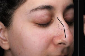 Rhinoplasty 1 After Image