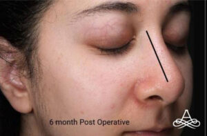Rhinoplasty 1 Before Image