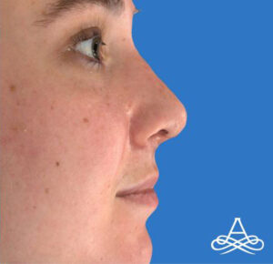 Rhinoplasty 2 Before Image