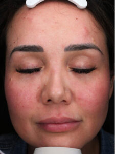 Rhinoplasty 4 After Image