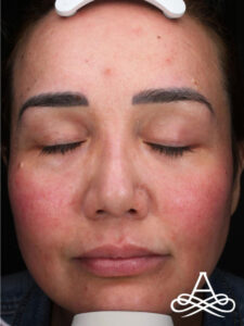 Rhinoplasty 4 Before Image