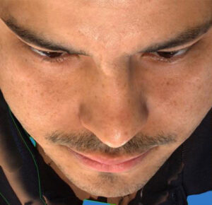 Rhinoplasty 5 After Image