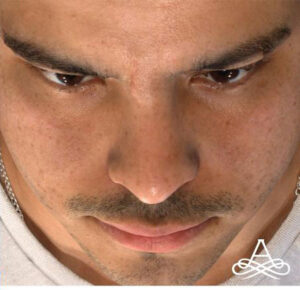 Rhinoplasty 5 Before Image