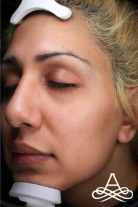 Rhinoplasty 6 Before Image