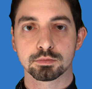 Rhinoplasty 8 After Image