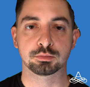 Rhinoplasty 8 Before Image