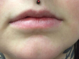 Lip Filler 10 After Image