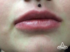 Lip Filler 10 Before Image