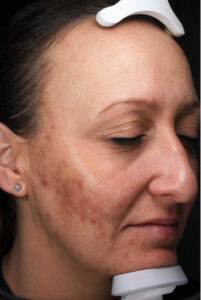 Acne Scars 1 After Image