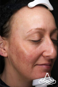 Acne Scars 1 Before Image
