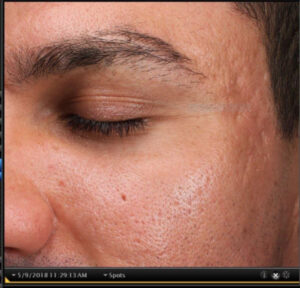 Acne Scars 4 After Image