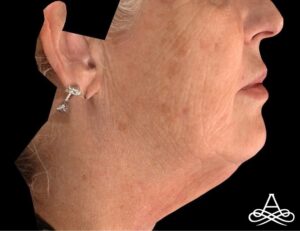 Neck Lift 1 After Image