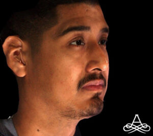 Rhinoplasty 10 Before Image